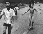 A child burned by Napalm